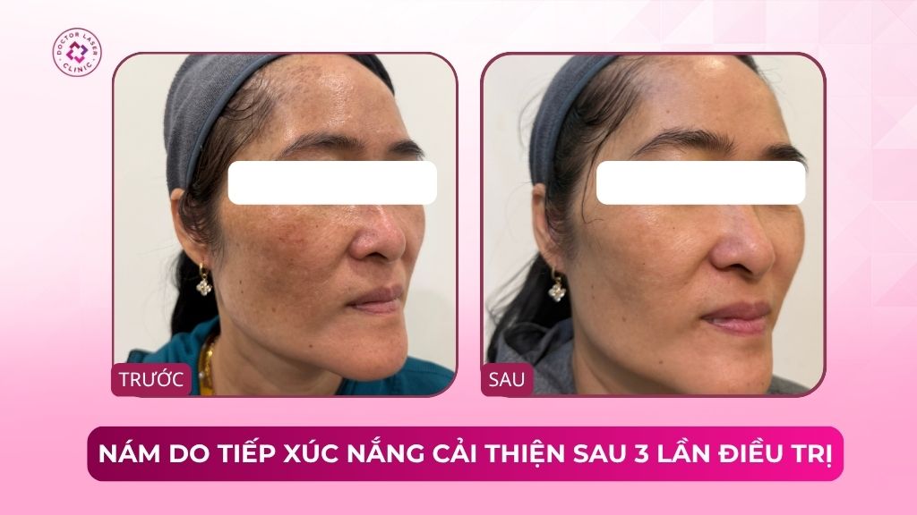 nám do tiếp xúc nắng cải thiện sau 3 lần điều trị