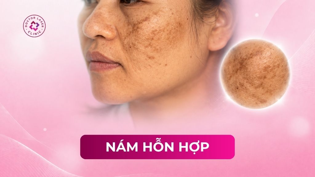 Nám hỗn hợp là gì? Nguyên nhân và cách điều trị chuẩn y khoa