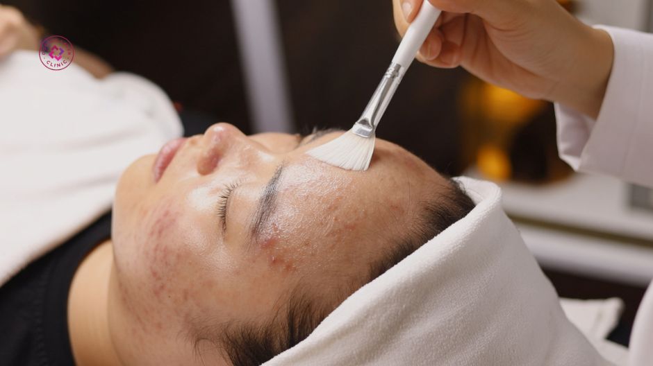 peel da hỗ trợ điều trị mụn