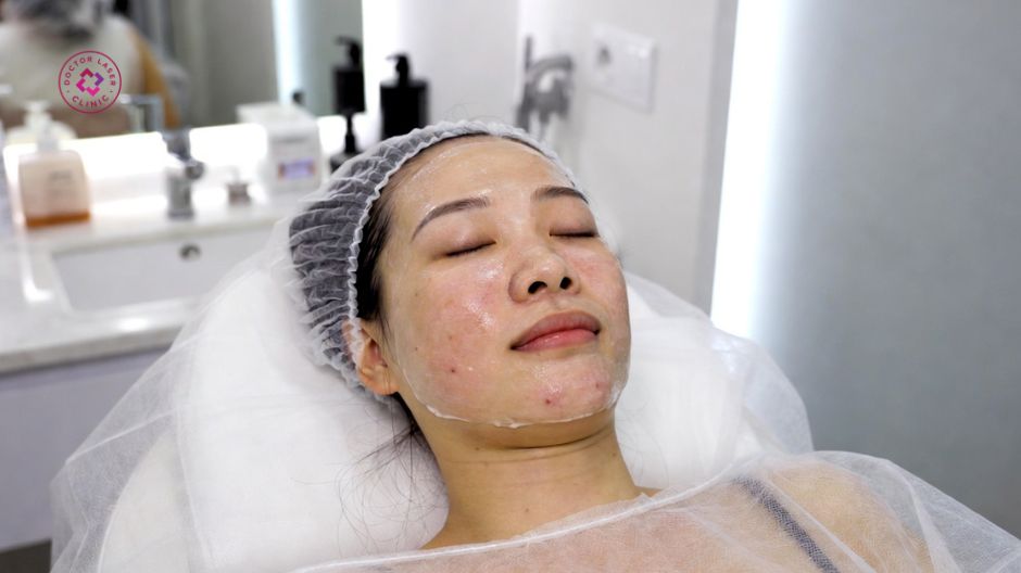 peel da hóa học hỗ trợ trị thâm mụn