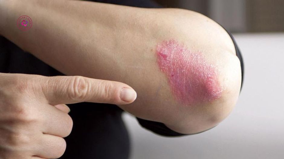 rối loạn nội tiết tố và bệnh lý gây thâm khuỷu tay
