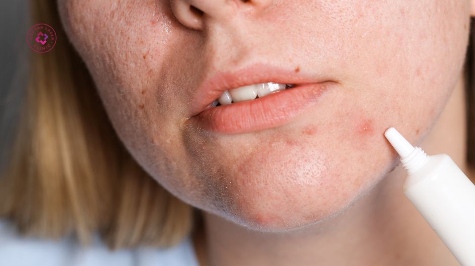 sản phẩm chấm mụn viêm cho da thâm mụn