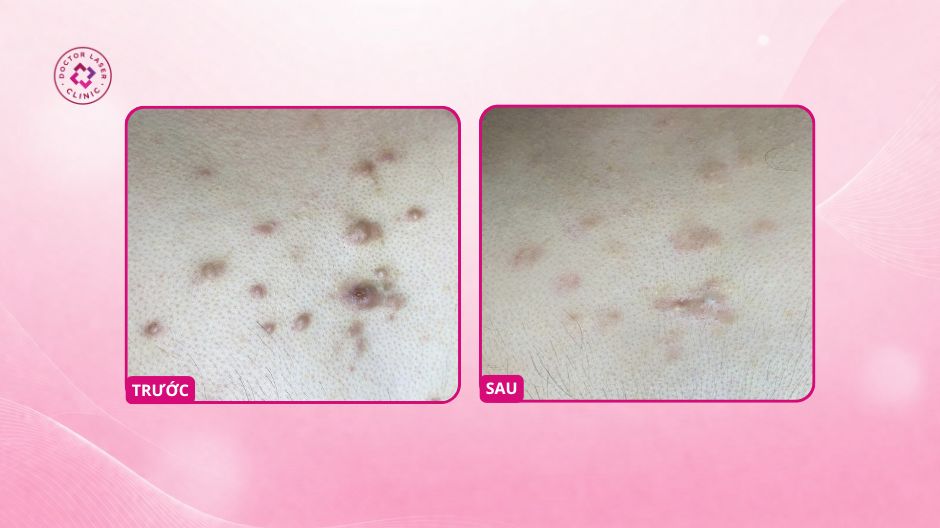sẹo lồi ngực eo sau tiêm corticoid