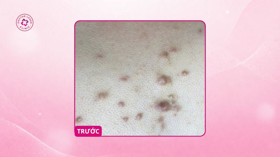 sẹo lồi ngực eo trước điều trị corticoid