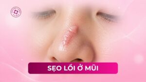 sẹo lồi ở mũi