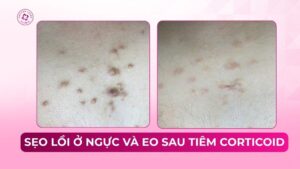 sẹo lồi ở ngực và eo sau tiêm corticoid