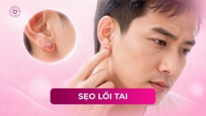 sẹo lồi tai sẹo lồi tai