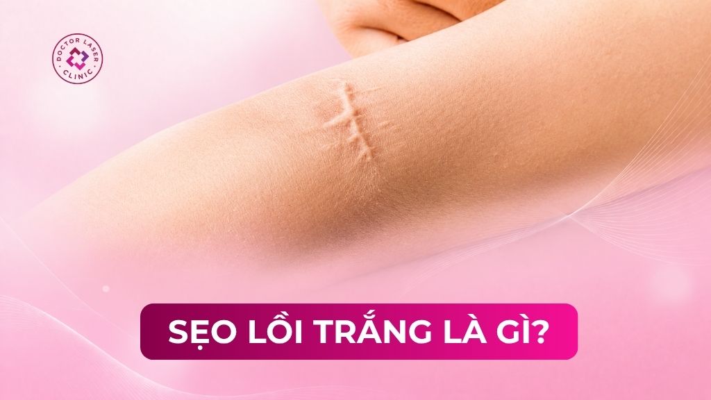 Sẹo lồi trắng là gì? Dấu hiệu, nguyên nhân và phương pháp điều trị