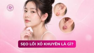 sẹo lồi xỏ khuyên là gì
