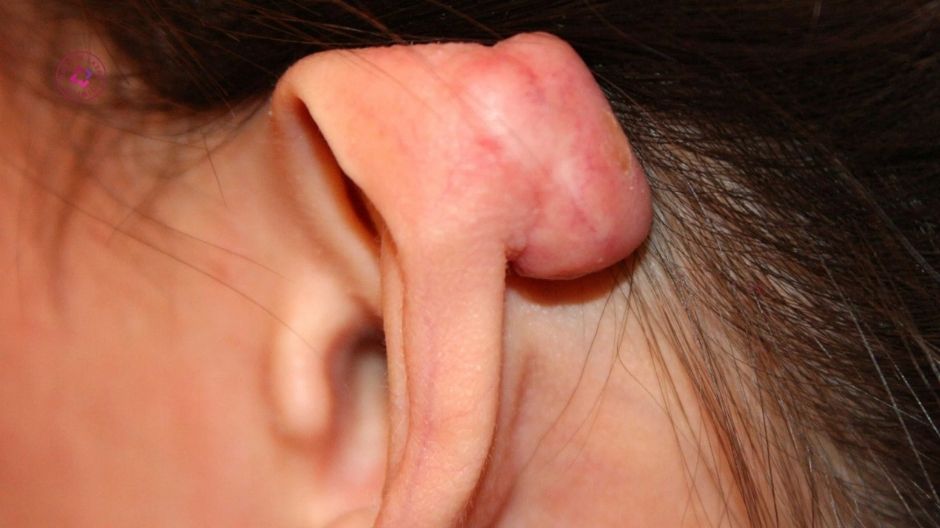 sẹo lồi xỏ khuyên