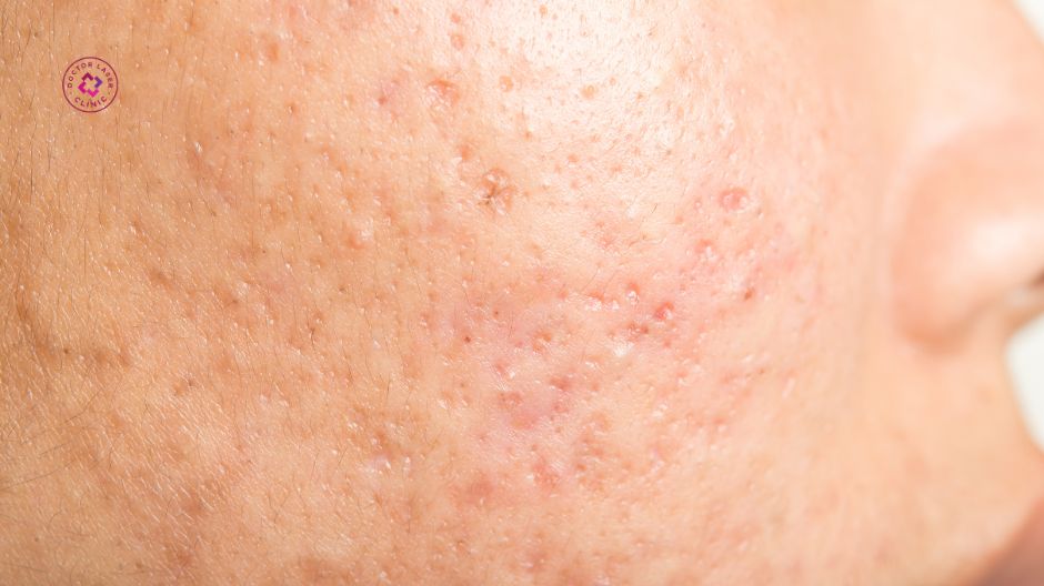 sẹo lõm sẹo rỗ là gì