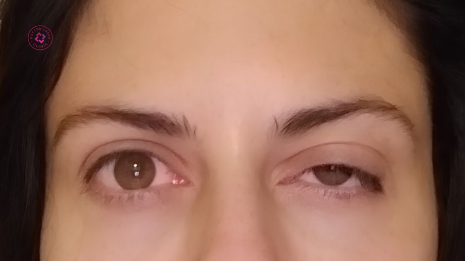 sụp mí và liệt cơ mắt sau tiêm filler