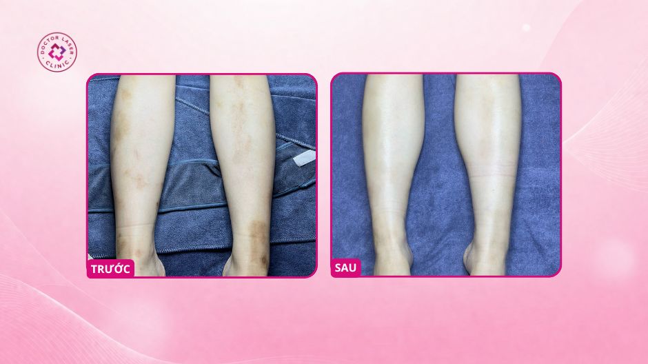 thâm chân sau côn trùng đốt sau blu peel