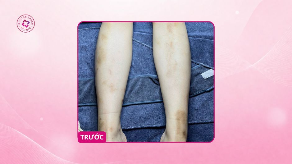 thâm chân sau côn trùng đốt trước điều trị