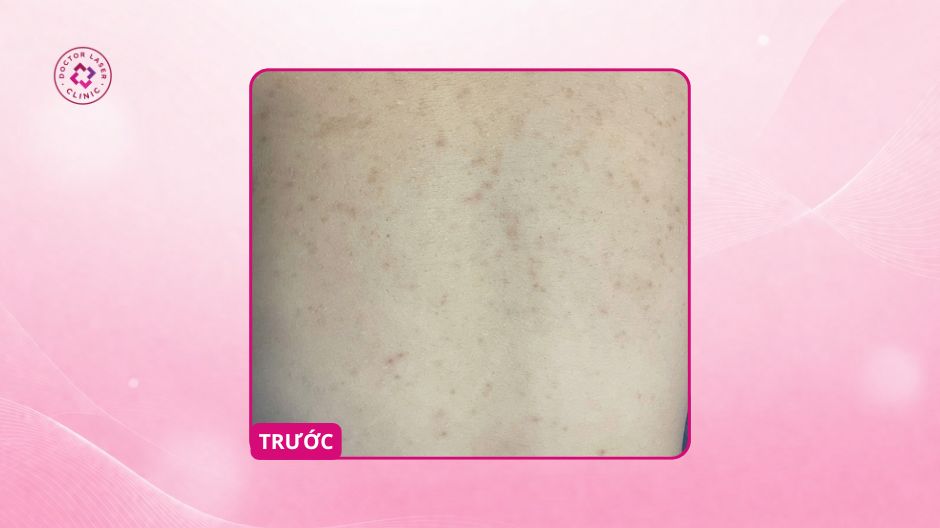 thâm lưng sau mụn trước điều trị