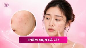thâm mụn là gì