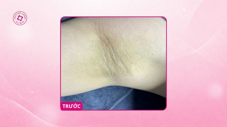 thâm nách trước điều trị peel