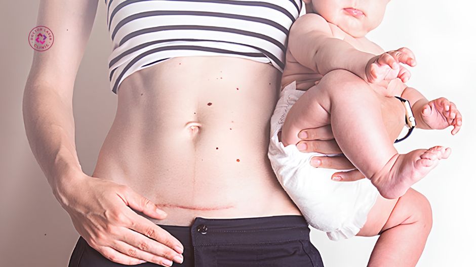 thay đổi nội tiết tố khi mang thai và sau sinh gây sẹo lồi