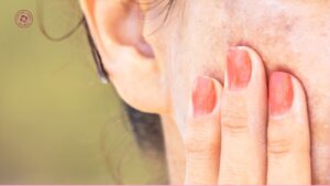 thức khuya có ảnh hưởng đến trị nám bằng laser