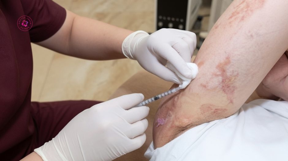 tiêm corticosteroid điều trị sẹo lồi co kéo