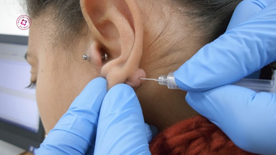 tiêm corticosteroid điều trị sẹo lồi tai