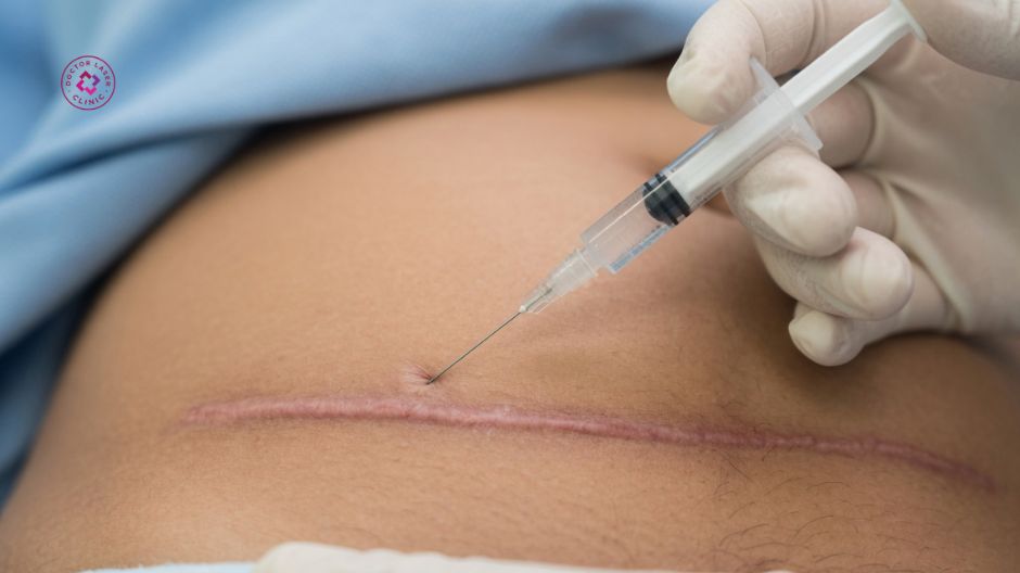 tiêm corticosteroid điều trị sẹo mổ đẻ bị lồi