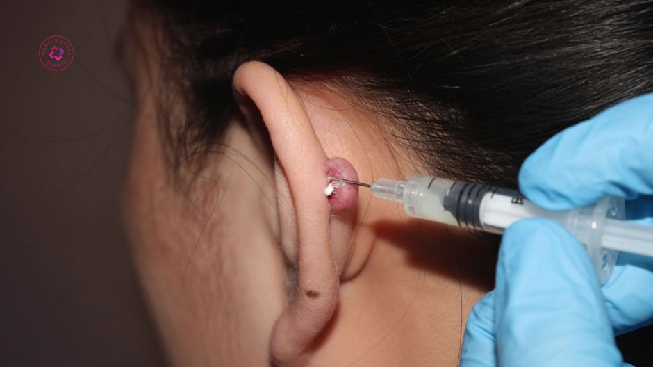 tiêm corticosteroid trị sẹo lồi xỏ khuyên