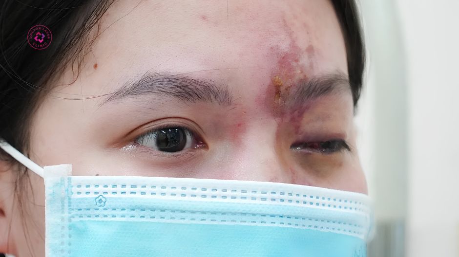 tiêm filler sai cách có thể gây mù mắt