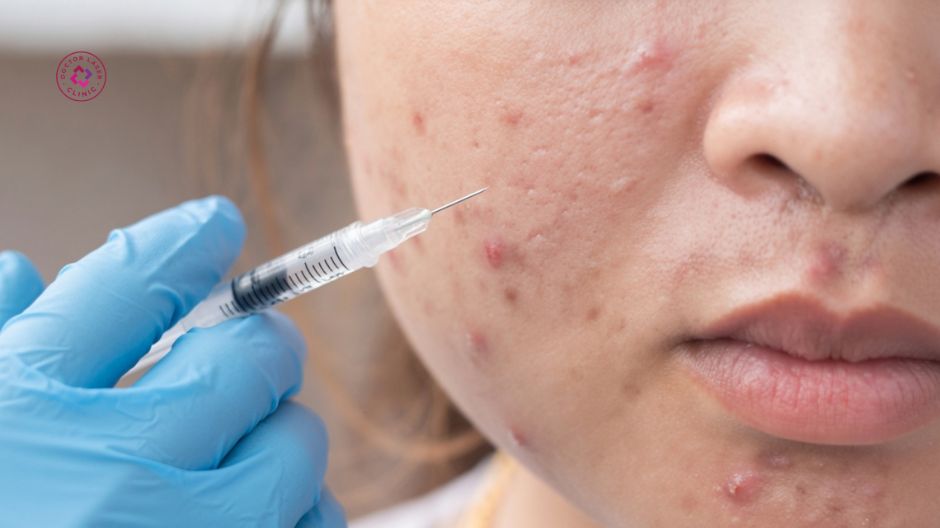 tiêm thuốc corticoid trị mụn nội tiết