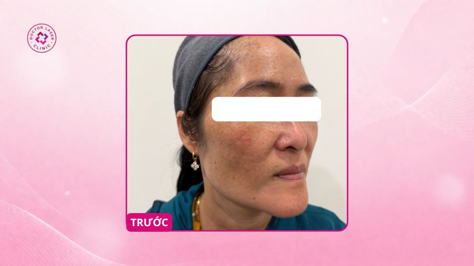 tình trạng nám trước điều trị laser pico