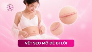 vết sẹo mổ đẻ bị lồi