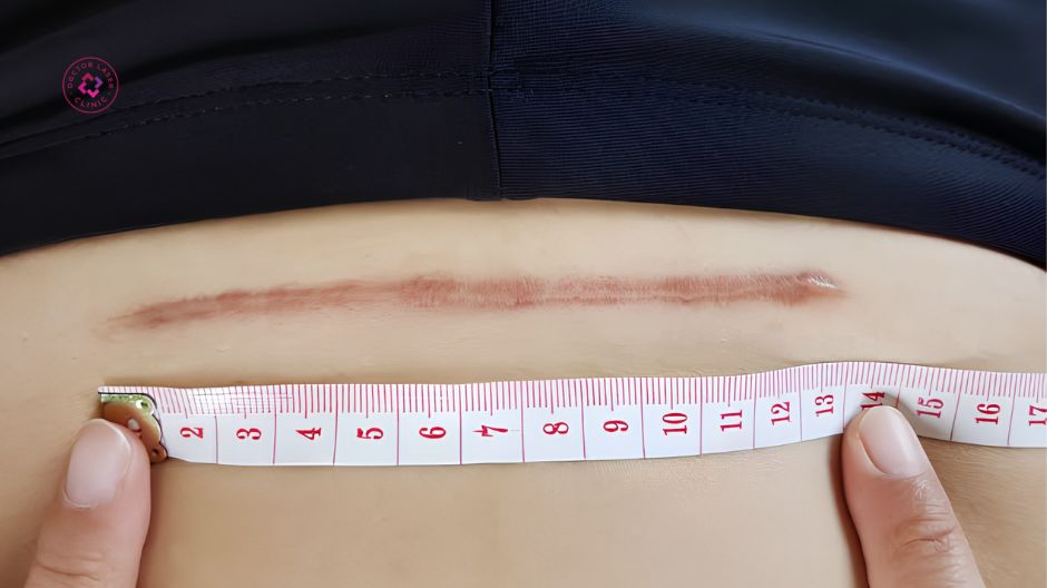 vết sẹo mổ đẻ bị lồi là gì