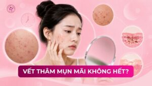 vết thâm mụn mãi không hết vết thâm mụn mãi không hết