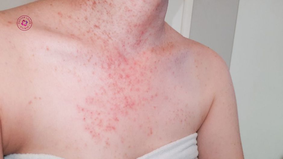 viêm nang lông và mụn nang gây sẹo lồi ở ngực