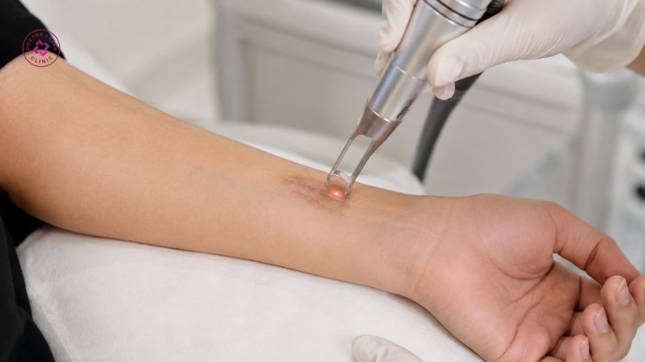 bắn laser điều trị vết bỏng bị thâm đen