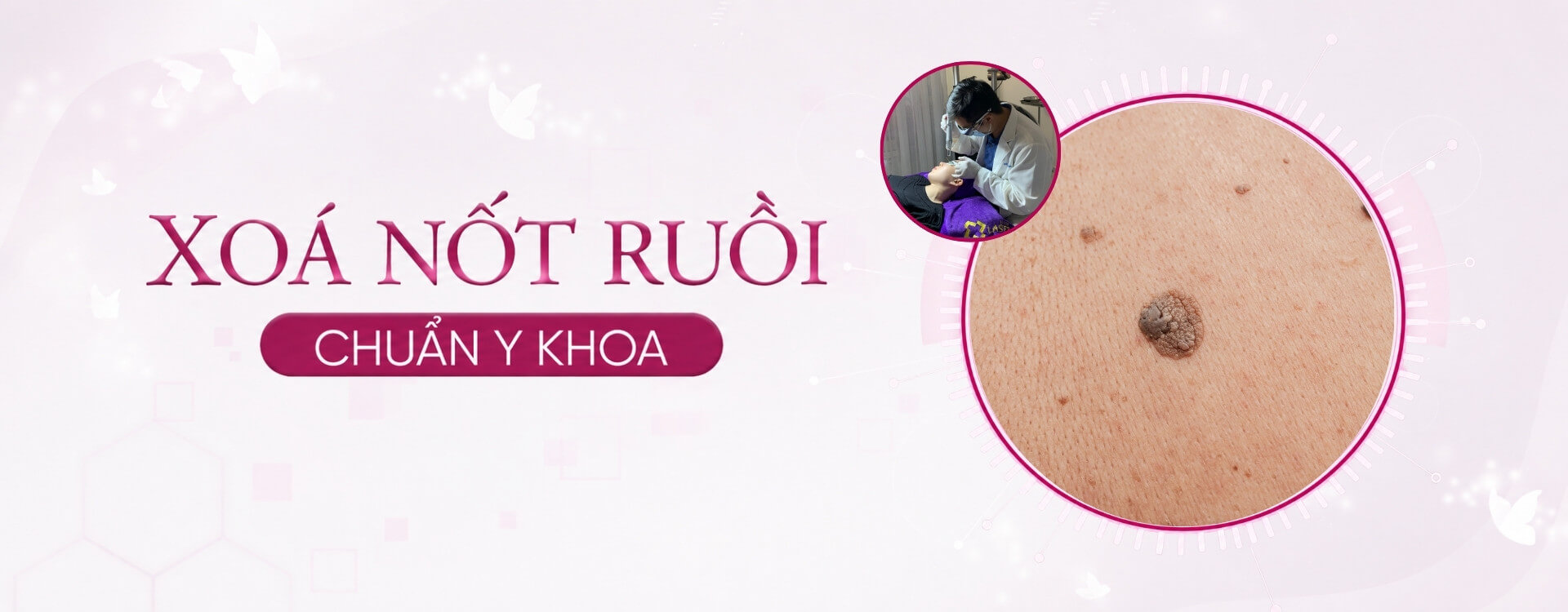 banner dịch vụ xóa nốt ruồi desktop