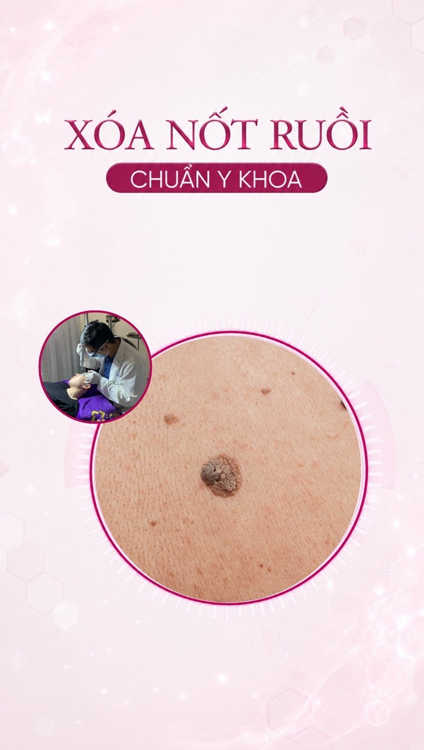 banner dịch vụ xóa nốt ruồi mobile