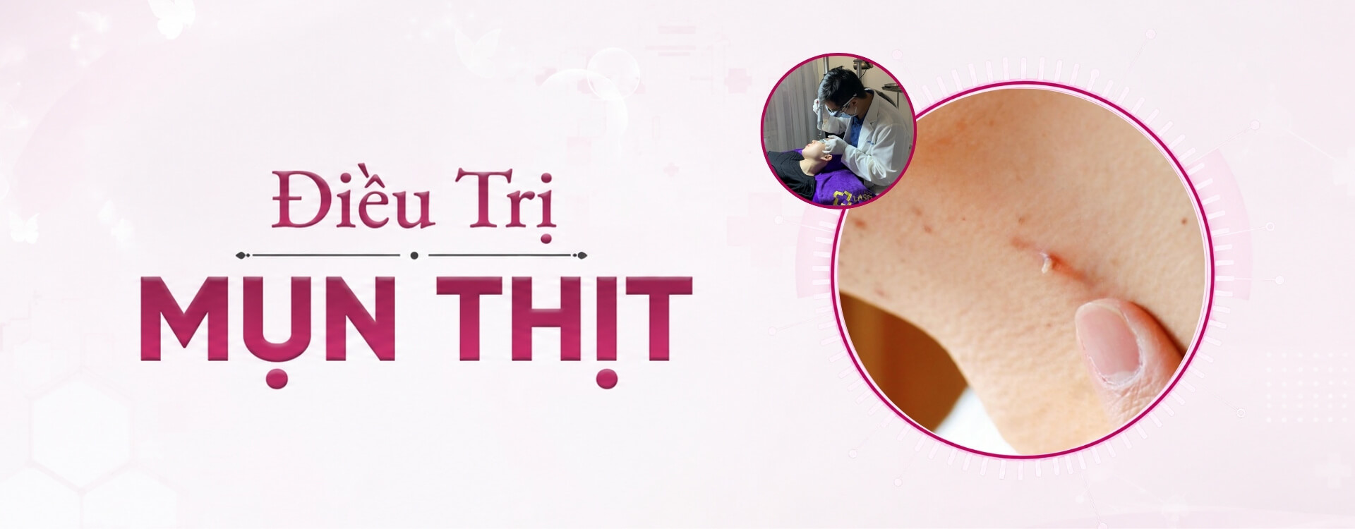 banner điều trị mụn thịt desktop