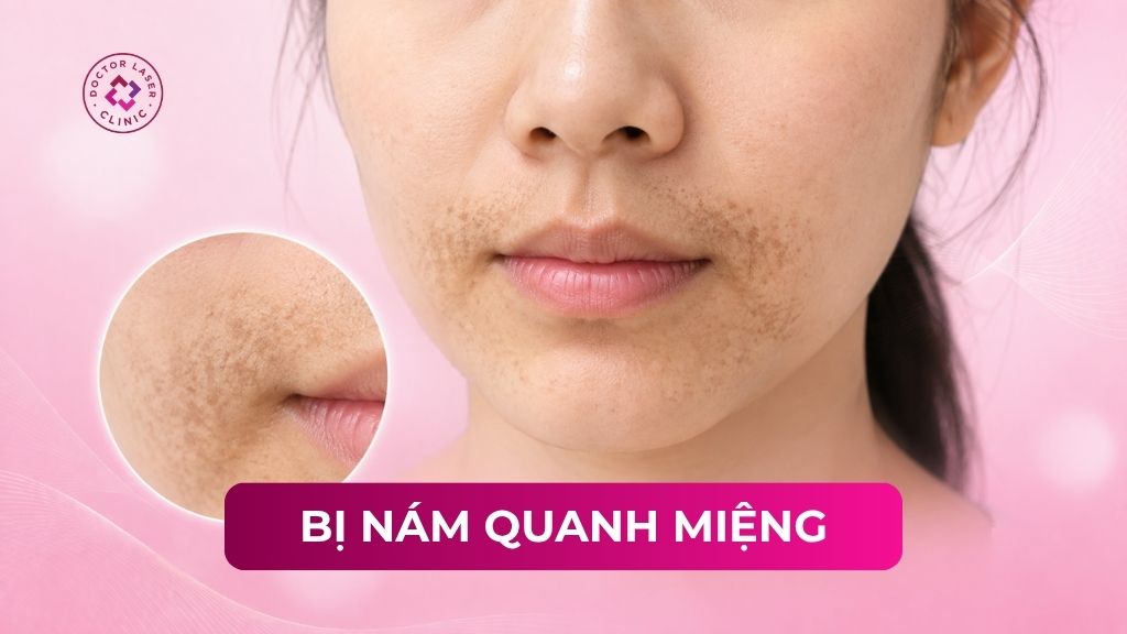 bị nám quanh miệng