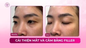cải thiện mắt và cằm bằng filler