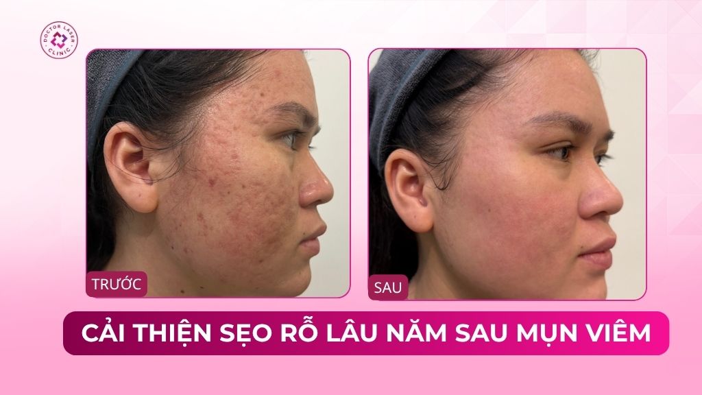 cải thiện sẹo rỗ lâu năm sau mụn viêm