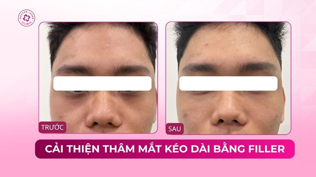 cải thiện thâm mắt kéo dài bằng filler