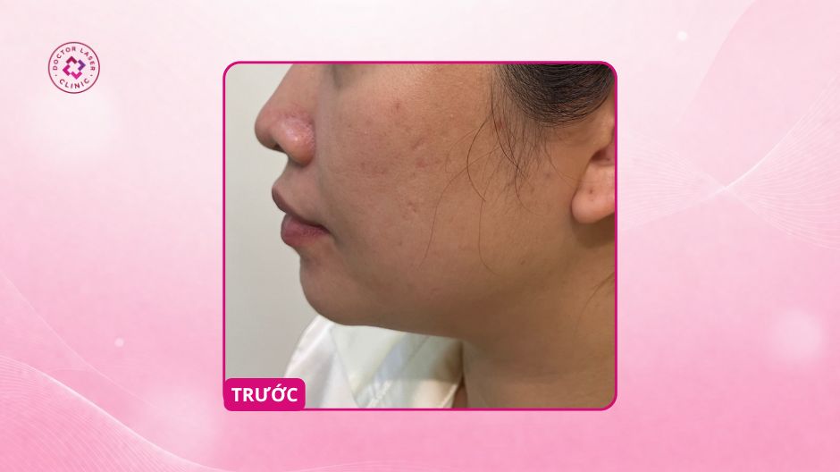 cằm thiếu cân đối trước tiêm ha