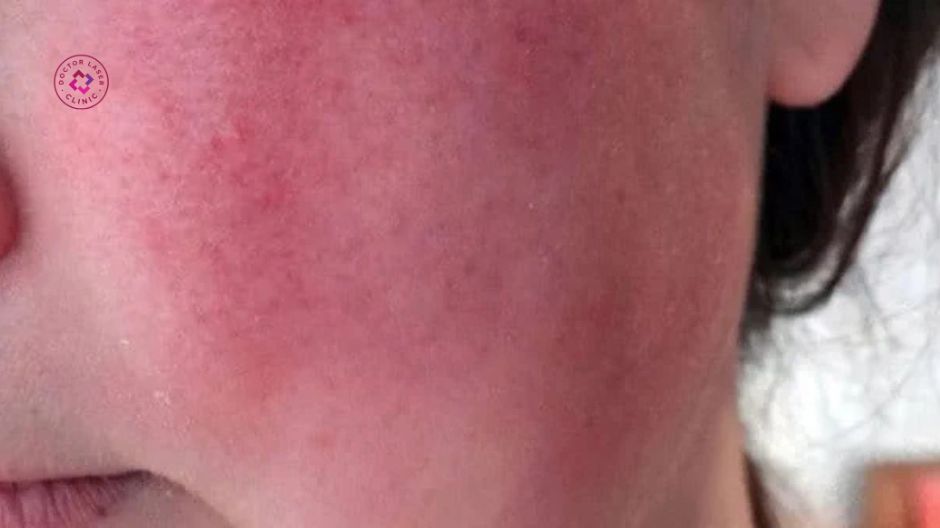 da bị đỏ và sưng nhẹ sau laser trị nám