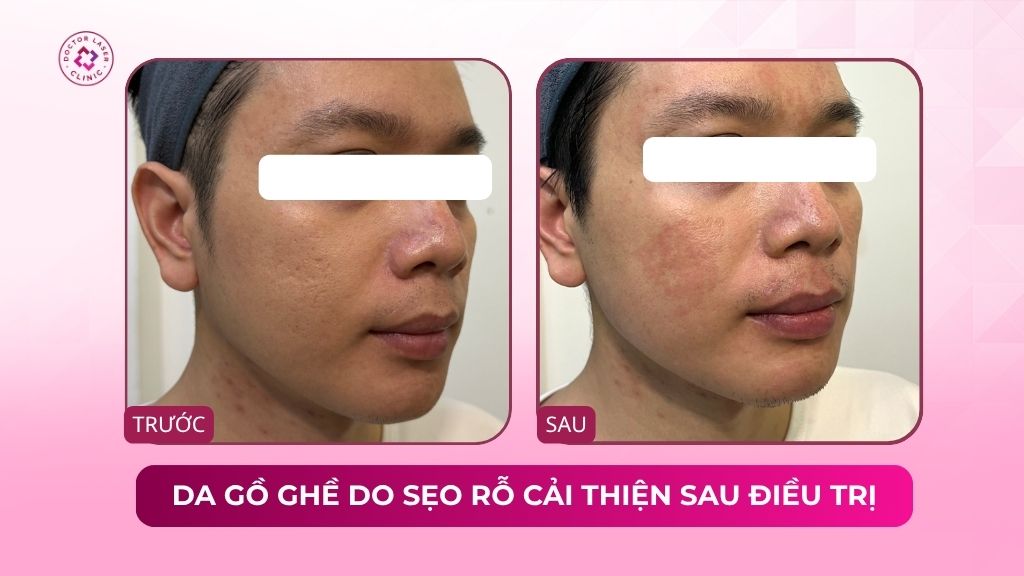 da gồ ghề do sẹo rỗ cải thiện sau điều trị