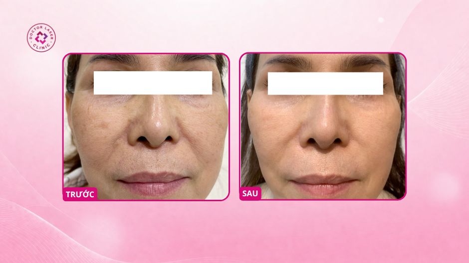 da sau điều trị prp