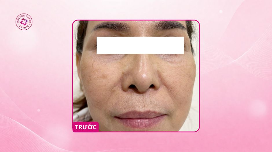 da trước điều trị prp