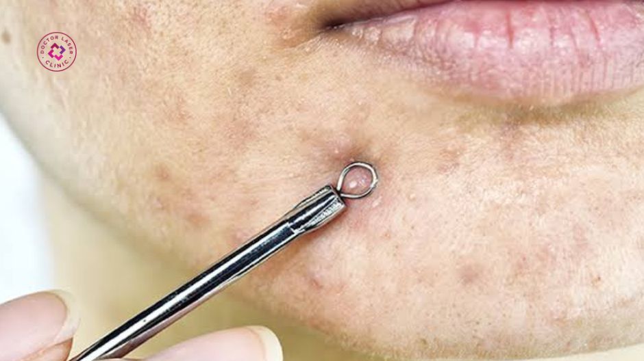 dấu hiệu nhận biết thâm mụn nặng