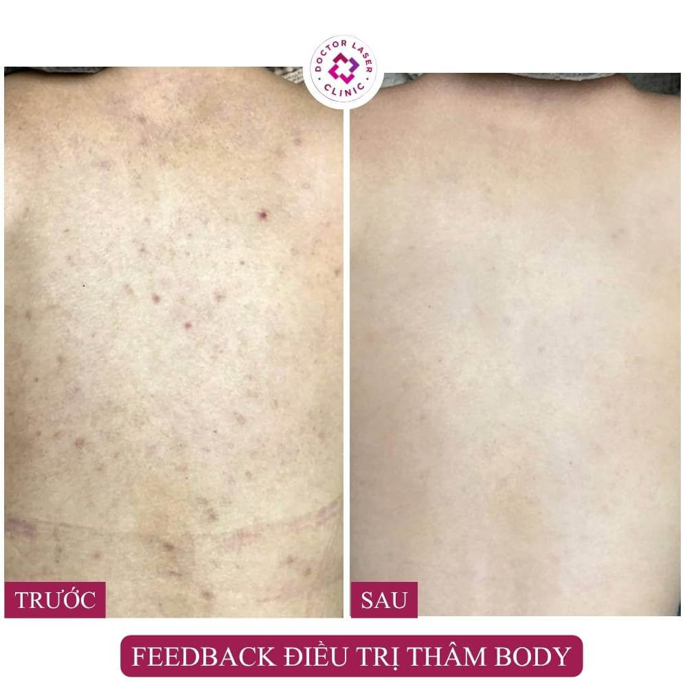 điều trị thâm body lưng