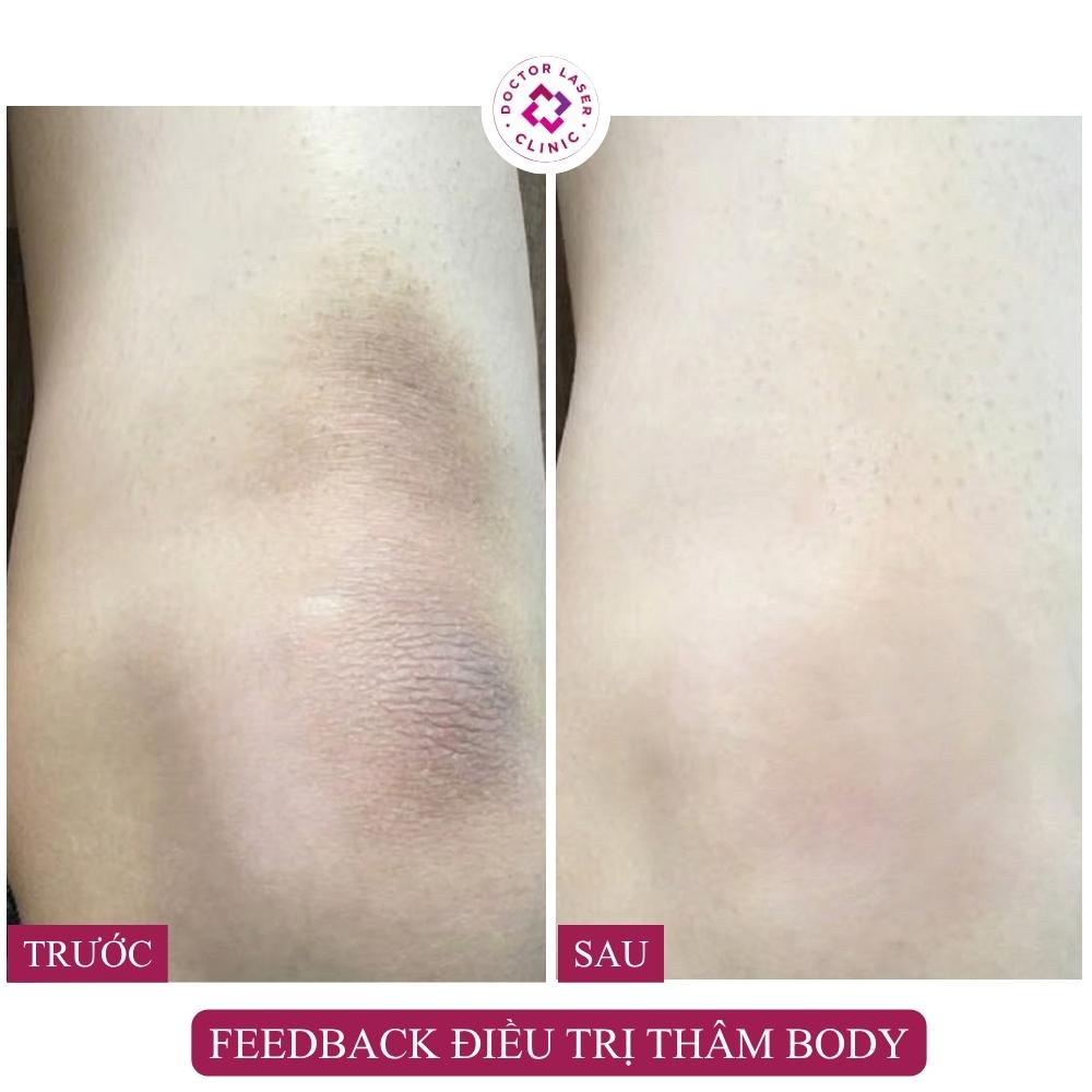 điều trị thâm đầu gối